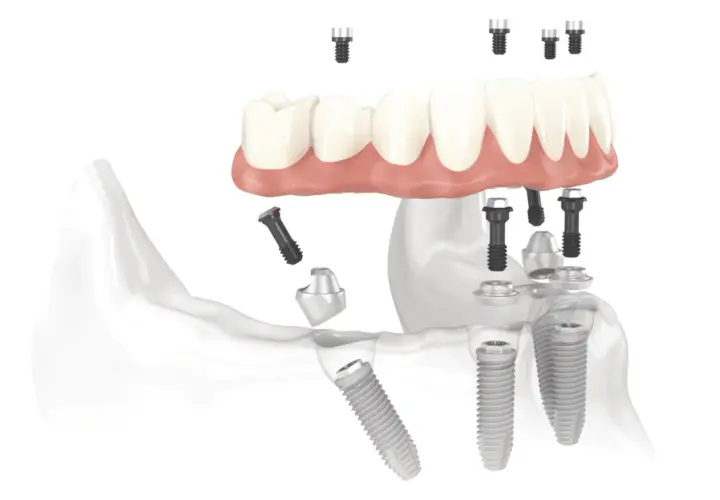 Impianti dentali e protesi, un ponte per un sorriso perfetto.