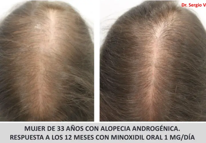 Comparativa de cabello de mujer de 33 años con alopecia androgenética, mostrando mejora tras 12 meses de tratamiento con minoxidil oral.