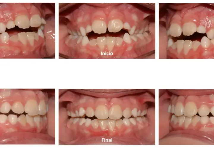 Niño con mordida abierta antes y después. Las imágenes muestran la corrección de la alineación dental, logrando una oclusión perfecta.