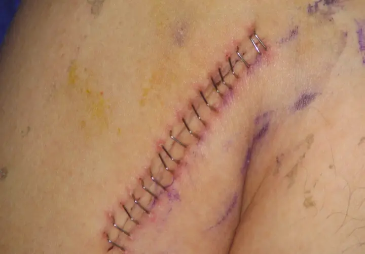 Gros plan sur une cicatrice suturée avec des agrafes chirurgicales. Un point de suture qui saute est visible, indiquant une possible complication.