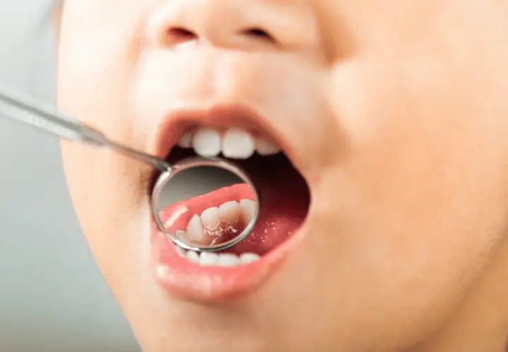 Bambino con bocca aperta e specchietto dentale. Si intravedono i denti, ma l'immagine suggerisce la preoccupazione per i denti marci nei bambini.