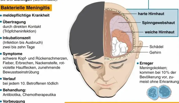 Hirnhautentzündung Diagnostik: So erkennen Sie die Symptome rechtzeitig