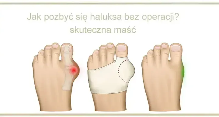 Bolące haluksy: Szybka ulga i skuteczne leczenie co działa?