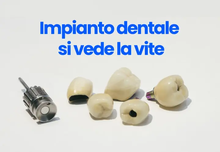 Componenti di un impianto dentale, inclusa una vite, su sfondo bianco.