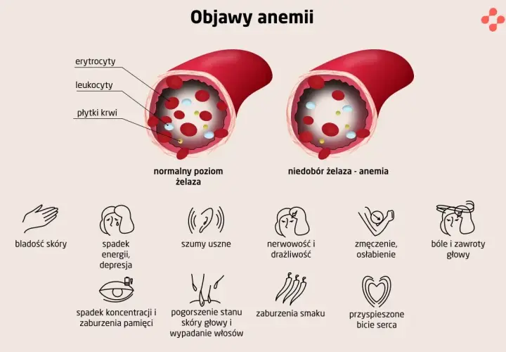 Objawy anemii: bladość, zmęczenie, bóle głowy. Czy anemia jest groźna? Ilustracja pokazuje różnicę w naczyniu krwionośnym przy normalnym poziomie żelaza i jego niedoborze.