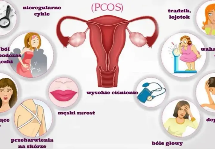 PCO syndrom co to jest - objawy, diagnoza i skutki zdrowotne