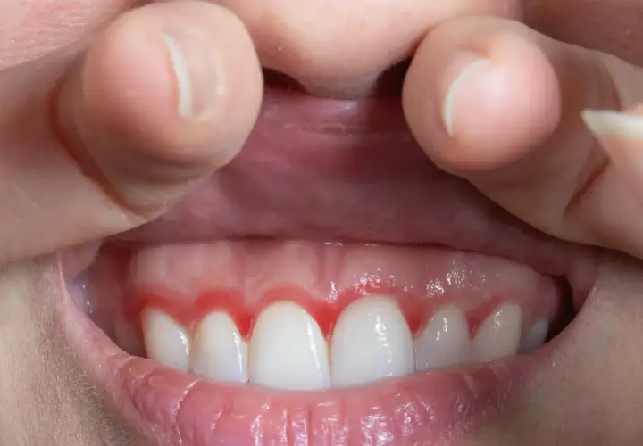 Dientes blancos con encía roja e inflamada alrededor.