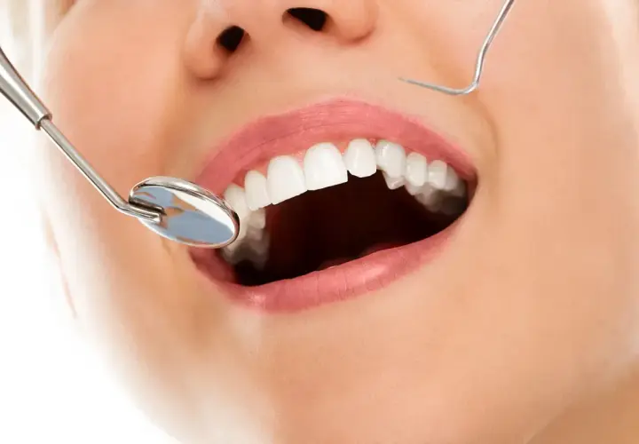 Uśmiechnięte usta z białymi zębami, lustro dentystyczne i sonda. Zabieg kiretaż może pomóc w osiągnięciu takiego efektu.