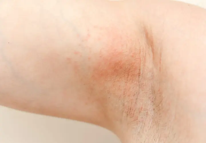 Czerwona, swędząca skóra pod pachą, objaw uczulenia na antyperspirant.
