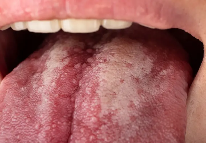 Lengua con manchas rojas y aspecto blanquecino, indicando posibles manchas rojas en la lengua y dolor de garganta.