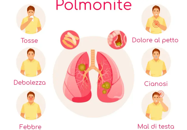 Polmonite: tosse, debolezza, febbre, dolore al petto, cianosi, mal di testa. L'immagine illustra i sintomi della polmonite, inclusa la polmonite ab ingestis.