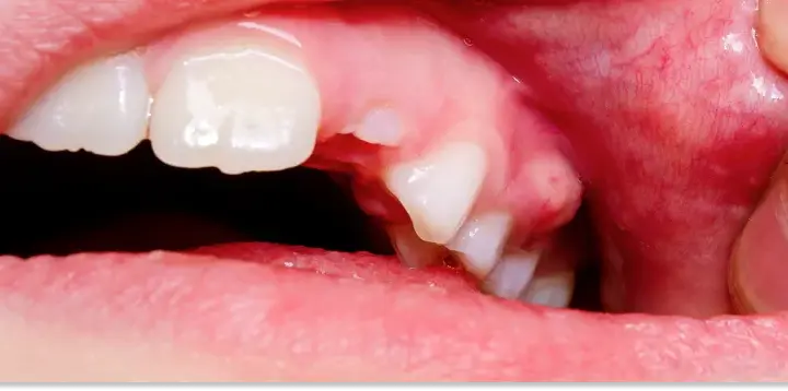 Opuchnięte dziąsła: Szybka ulga domowymi sposobami i kiedy do dentysty
