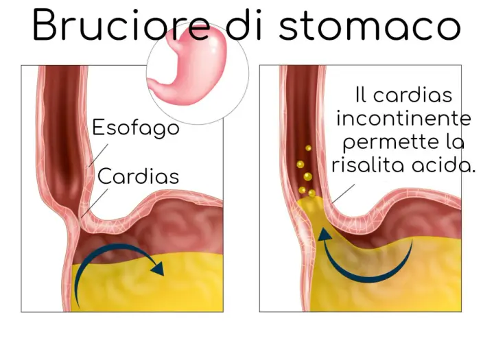 Illustrazione del bruciore di stomaco: il cardias incontinente permette la risalita acida, causando fitte allo stomaco.