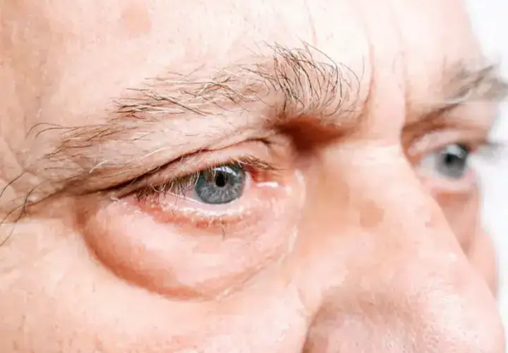 Occhi con evidenti borse sotto, forse un segnale di affaticamento o problemi al fegato.
