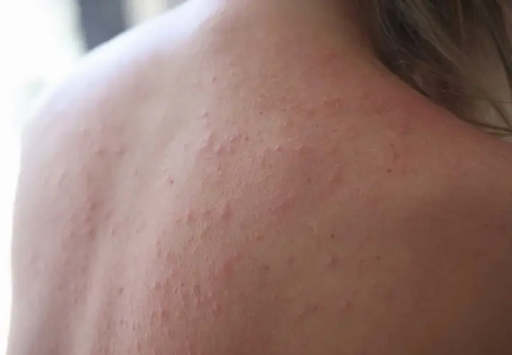 När solen bränner kan huden reagera med små röda prickar och utslag. Här ser du hur soleksem kan se ut på ryggen.