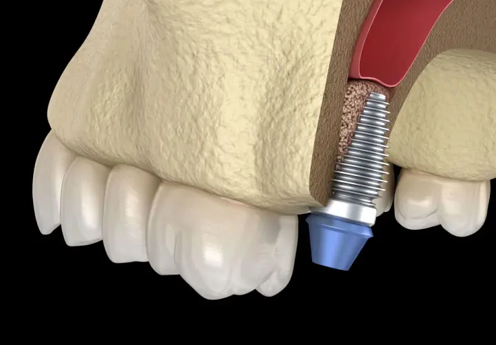 Impianto dentale vicino al seno mascellare. Il rialzo seno mascellare presenta rischi, ma questa immagine mostra la procedura.