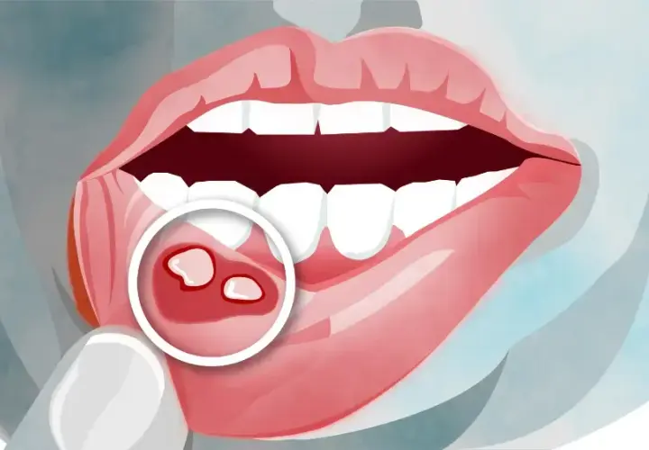 Masz aftę? Czy możesz iść do dentysty? Sprawdź zanim pójdziesz!