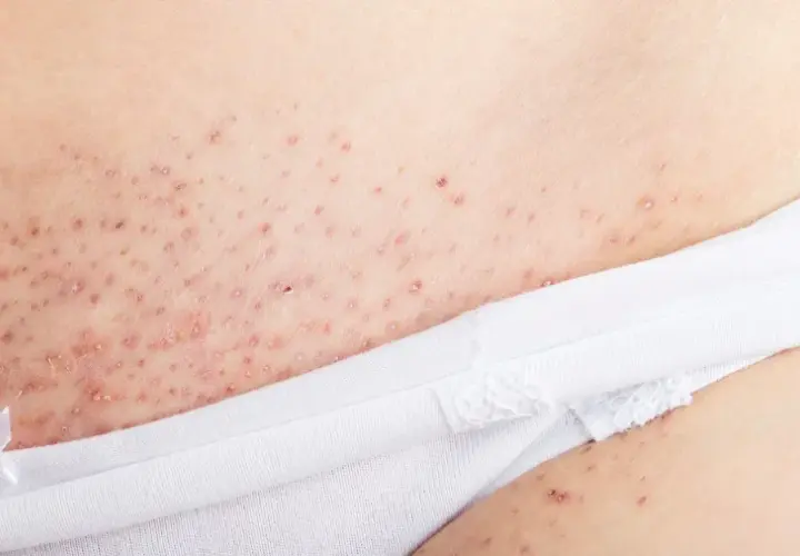 Hudirritation med små röda prickar och rakfinnar underlivet, synligt nära en vit troskant.