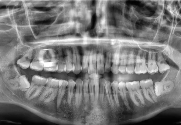 Radiografía panorámica dental. Se observa una muela del juicio impactada, inclinada hacia la mejilla, con posible presión sobre el diente adyacente.