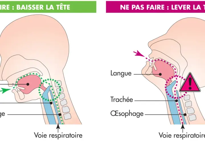 Illustration montrant la bonne (tête baissée) et la mauvaise (tête levée) position pour manger, afin d'éviter la difficulté à avaler et l'obstruction des voies respiratoires.