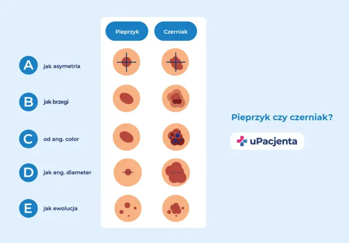 Porównanie pieprzyka i czerniaka: asymetria, brzegi, kolor, średnica i ewolucja. Grafika edukacyjna uPacjenta.