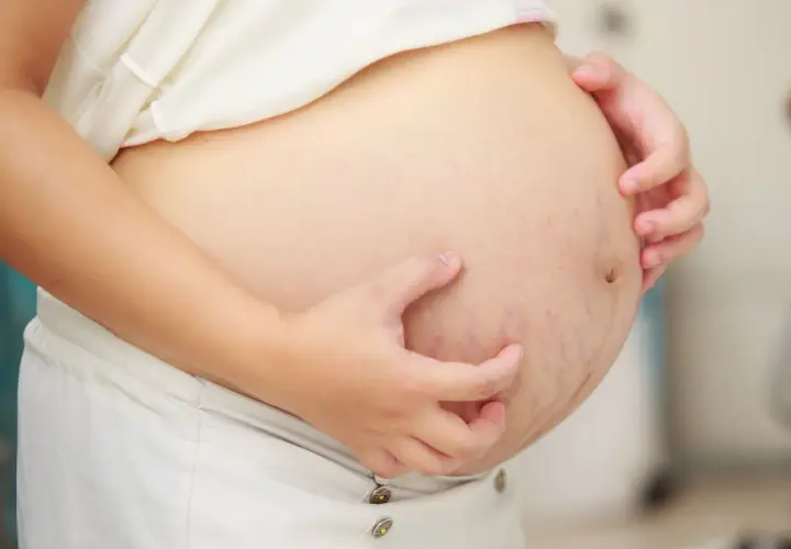 Ventre de femme enceinte avec vergetures, une main se gratte. Le ventre qui gratte signification est souvent liée à l'étirement de la peau.