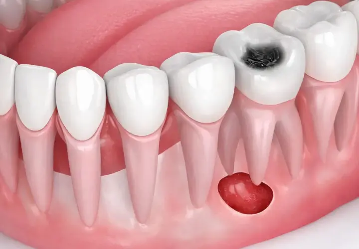 Diente con caries y un quiste odontogénico en la encía.