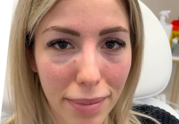 Ansiktsbild av en kvinna med synliga porer och rodnad. Hon har mörka ögonfransar och ljusblont hår. Under ögonen syns en antydan till mörka ringar, vilket kan behandlas med tear trough filler.