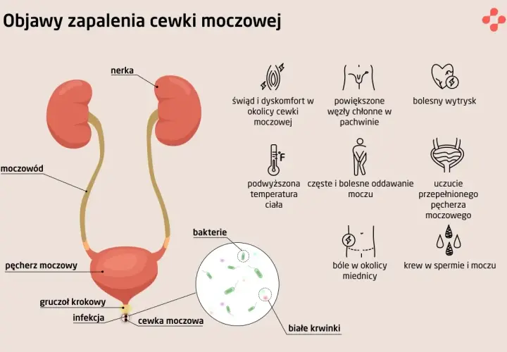 Ilustracja przedstawia układ moczowy i objawy zapalenia cewki moczowej: ból, pieczenie, obecność bakterii i białych krwinek w cewce moczowej.