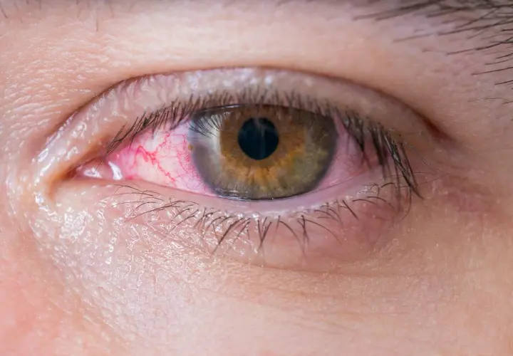 Ojo irritado con venas rojas visibles. Parece el ojo de un niño con ojos rojos por alergia o conjuntivitis.