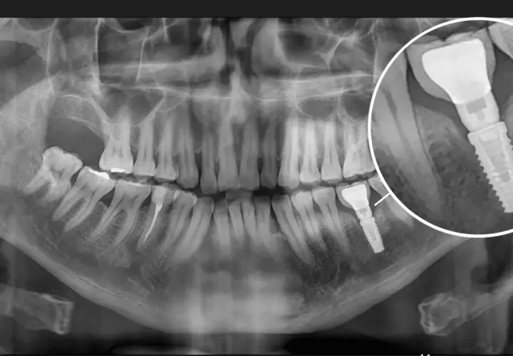 RTG szczęki z widocznym implantem stomatologicznym. Powiększony fragment pokazuje szczegóły augmentacji kości i samego implantu.