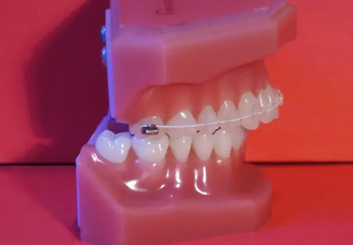 Modelo de dientes con ortodoncia, mostrando cómo los **dientes inclinados hacia afuera** se corrigen.