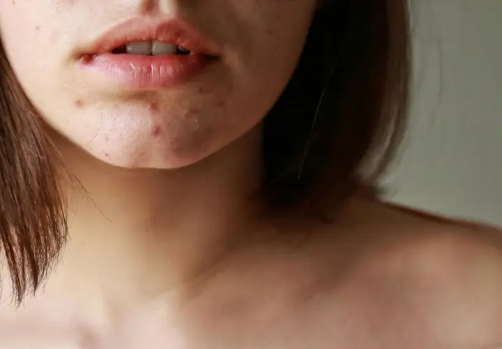 Nahaufnahme von Lippen und Kinn mit Pickeln, die auf Hautveränderungen in den Wechseljahren hindeuten.