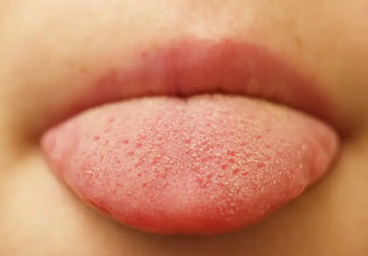 Lingua rossa con piccole bollicine, forse un bambino ha assaggiato qualcosa di nuovo e frizzante!