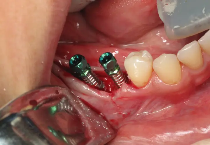 Due viti per impianto dentale sono visibili nella gengiva, pronte per la guarigione. Il dolore post-operatorio è comune, ma gestibile.