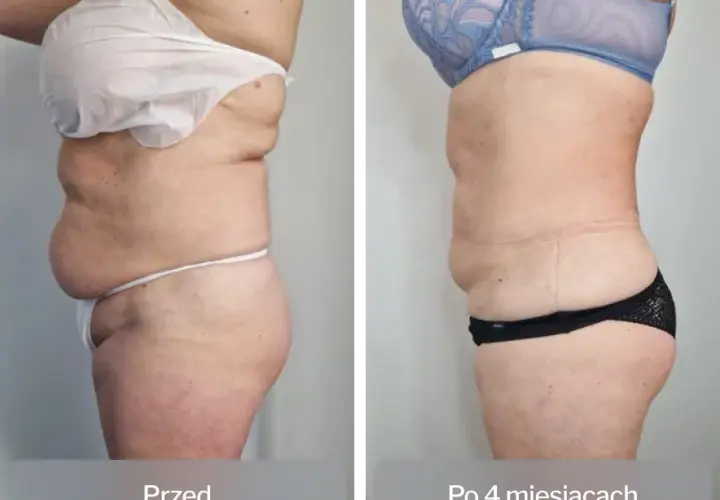 Liposukcja: Co to, metody, efekty i koszty? Pełny przewodnik!