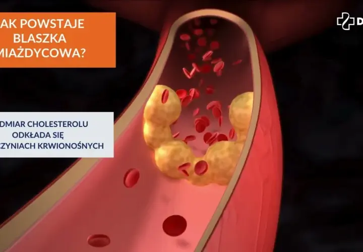 Cholesterol całkowity 220: Granica, sygnał, czy zagrożenie?