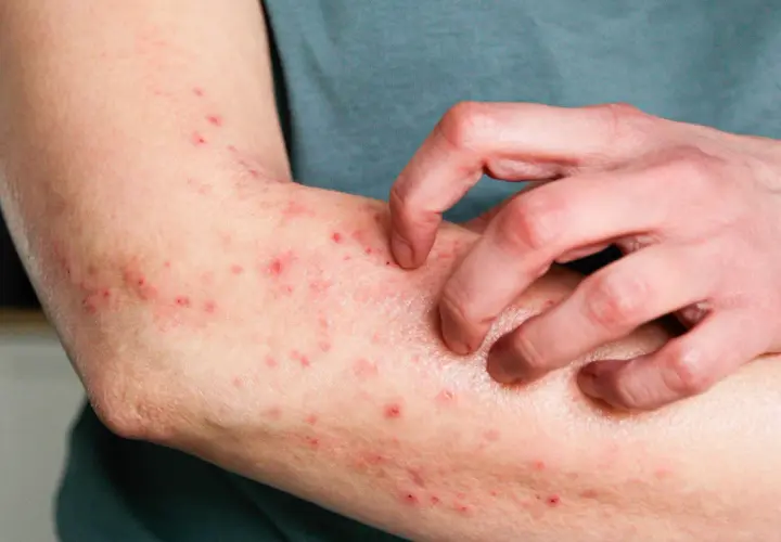 Ramię pokryte czerwonymi krostami alergicznymi, które swędzą i drapią się.