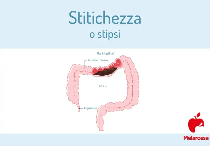 Illustrazione del colon con feci accumulate e gas intestinali, che indica stitichezza. Una purga intestinale potrebbe aiutare.