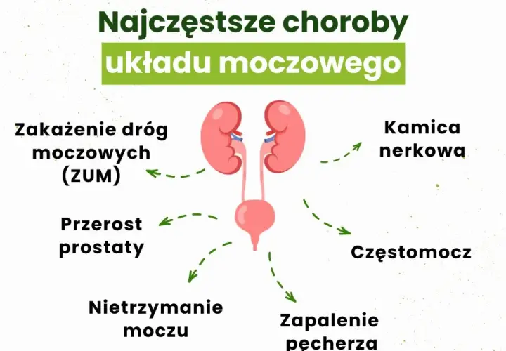 Przyczyny zapalenia pęcherza moczowego: co musisz wiedzieć, aby uniknąć problemów
