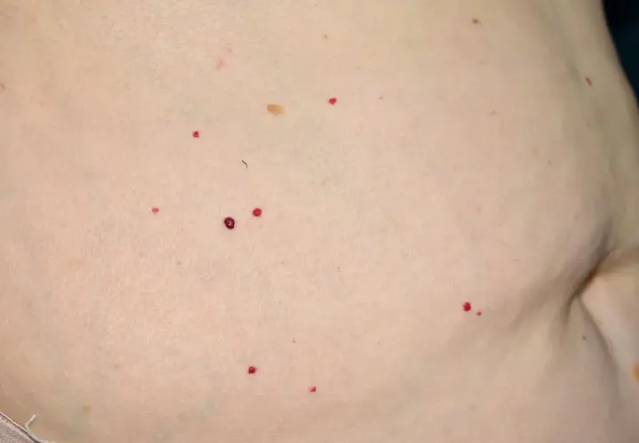 Nagły wysyp punktów rubinowych na skórze, niektóre większe, inne mniejsze, przypominające drobne kropki.