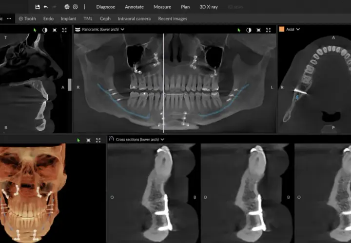 CBCT co to? Obraz przedstawia skany 3D szczęki i żuchwy z implantami, pokazujące szczegółową anatomię kości i zębów.