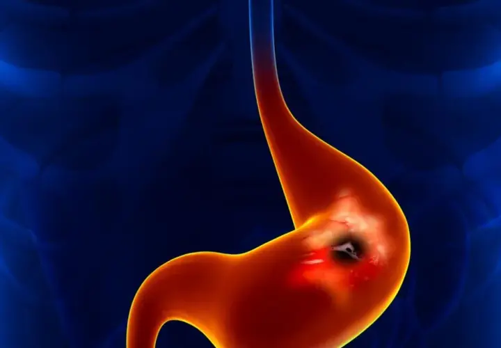 Wrzód żołądka spowodowany przez Helicobacter pylori. Objawy psychiczne mogą towarzyszyć tej chorobie.