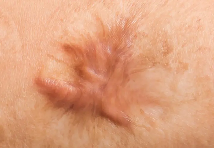 Gros plan d'une cicatrice hypertrophique sur la peau, ressemblant à une cloque sur cicatrice.