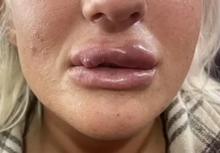 En närbild på en persons läppar och näsa, med synlig svullnad och en liten knöl på underläppen efter fillers.