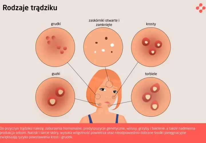 Ilustracja przedstawia różne rodzaje trądziku: grudki, guzki, zaskórniki, krosty i torbiele.