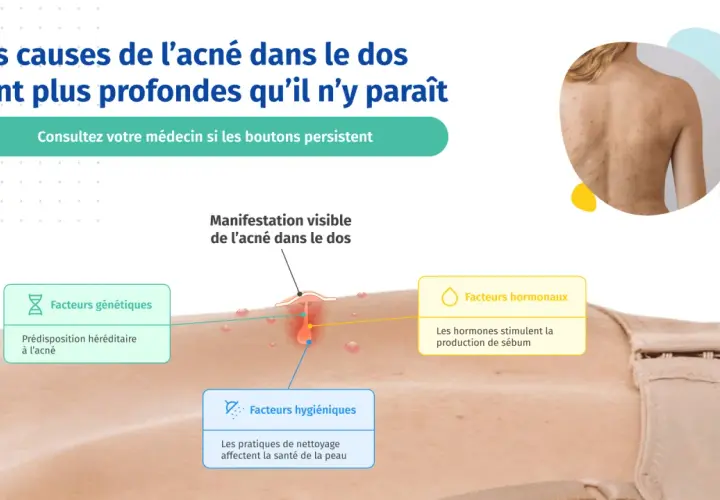 Illustration expliquant les causes de l'acné du dos chez l'adolescent : facteurs génétiques, hormonaux et hygiéniques.