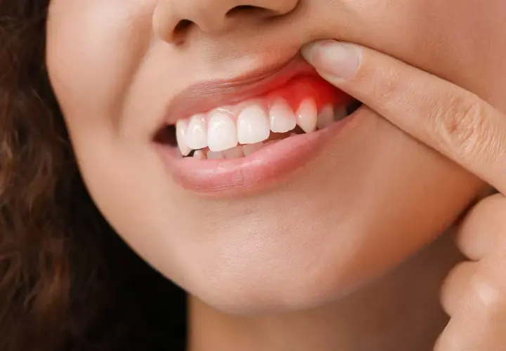 Dito che indica una gengiva arrossata e gonfia, sintomo di un possibile ascesso dentale.