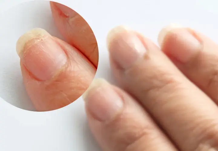 Paznokcie z łuszczącą się płytką, mogą być jednym z objawów wysokiego cholesterolu.