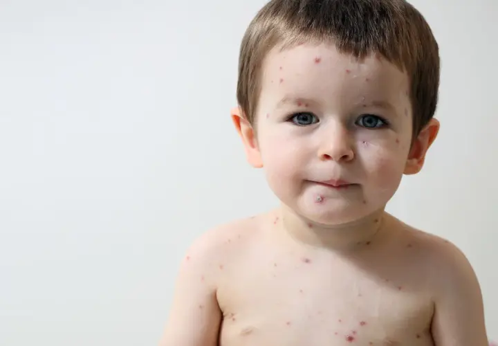 Bambino con macchie rosse sul viso e sul corpo, tipiche delle malattie esantematiche infantili.